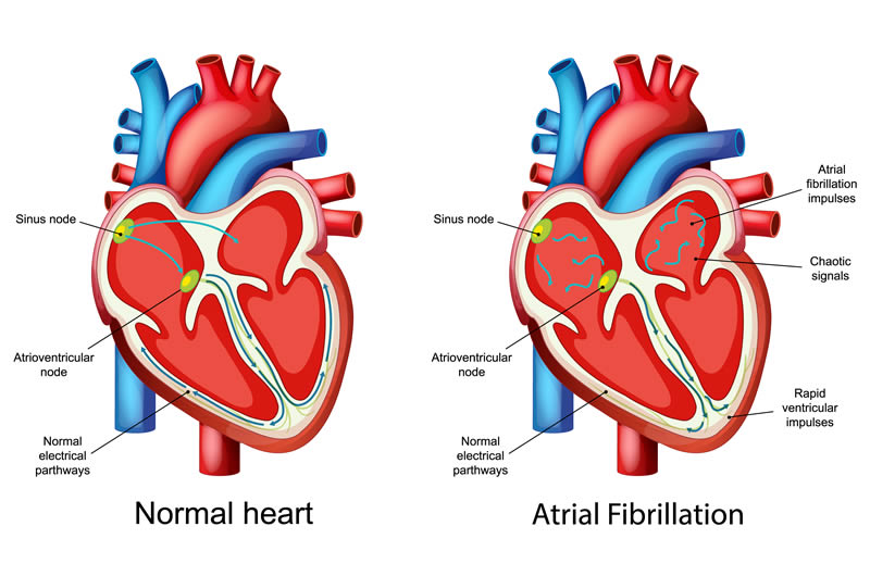 diagram of the heart showing atrial fibrilation